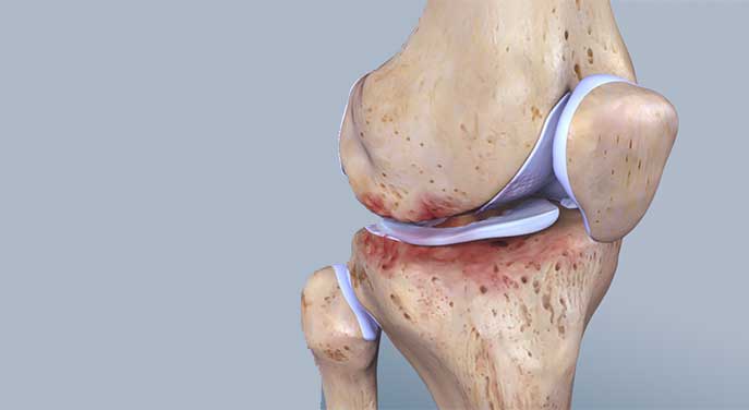Why do more females than males get knee osteoarthritis?
